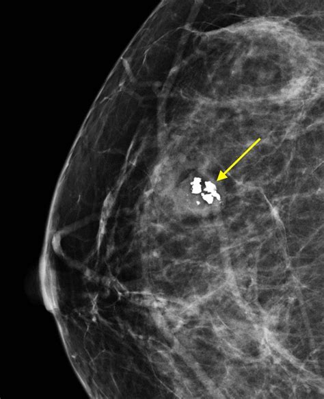What Mammograms Show: Calcifications, Cysts, Fibroadenomas.
